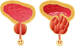 Normal prostate and inflamed